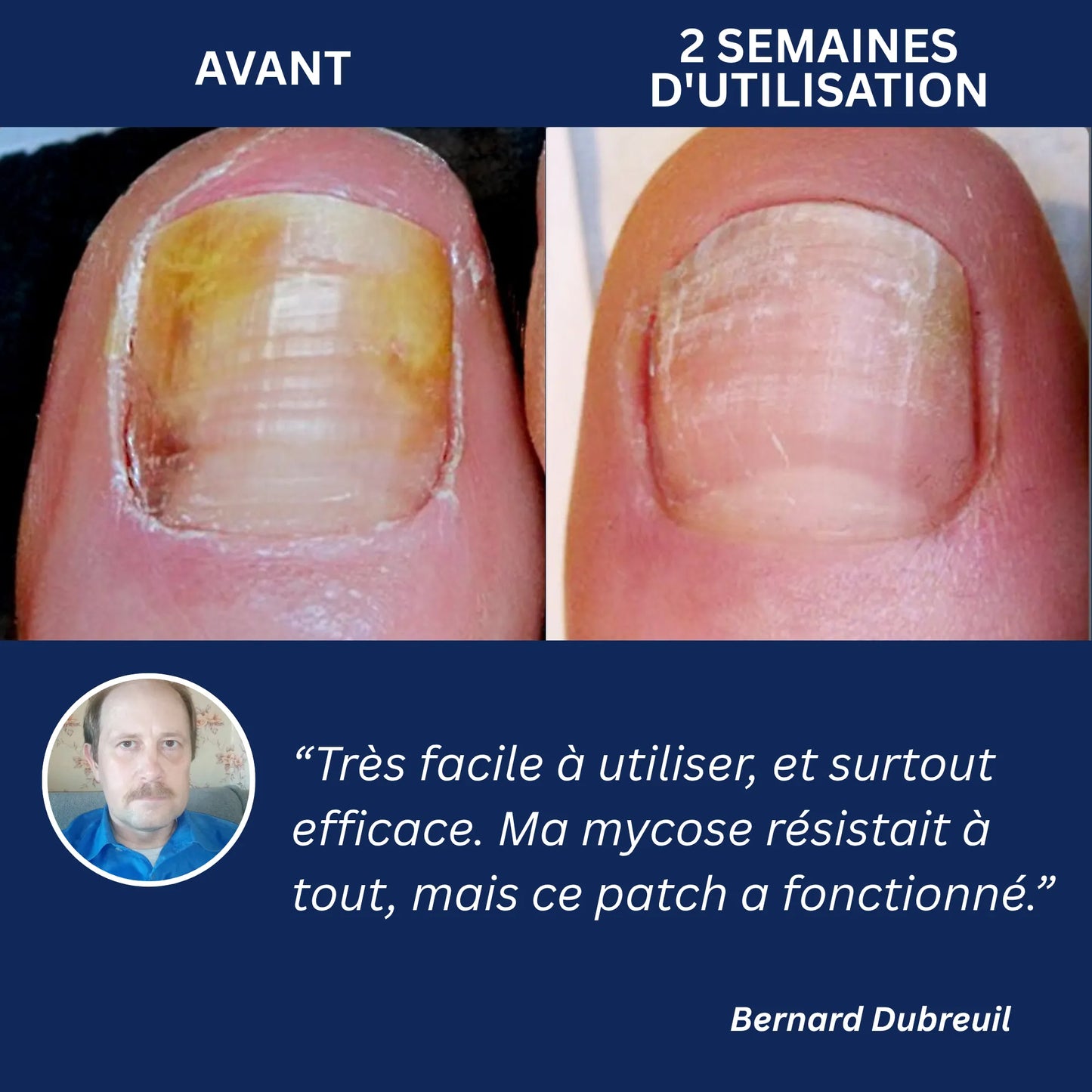 OnyxClair™ - Patchs Ongles Fongiques