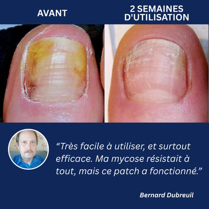 OnyxClair™ - Patchs Ongles Fongiques