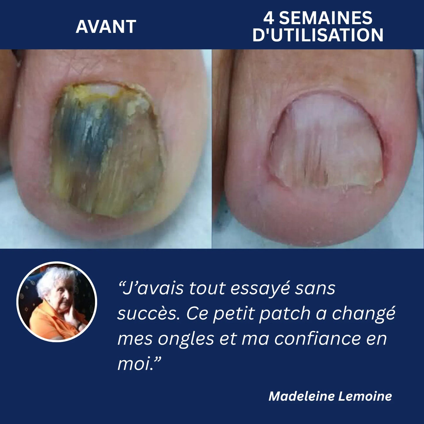 OnyxClair™ - Patchs Ongles Fongiques