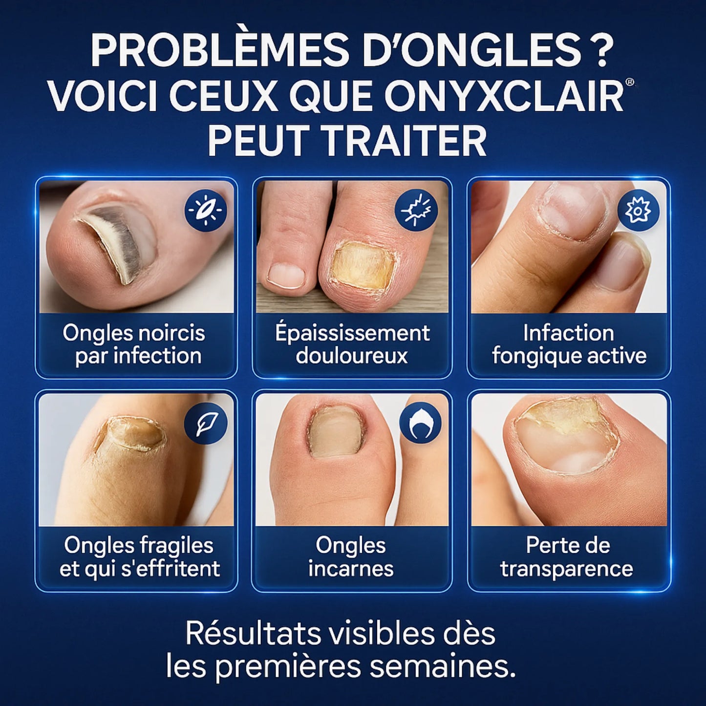 OnyxClair™ - Patchs Ongles Fongiques