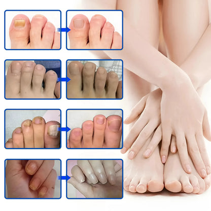OnyxClair™ - Patchs Ongles Fongiques